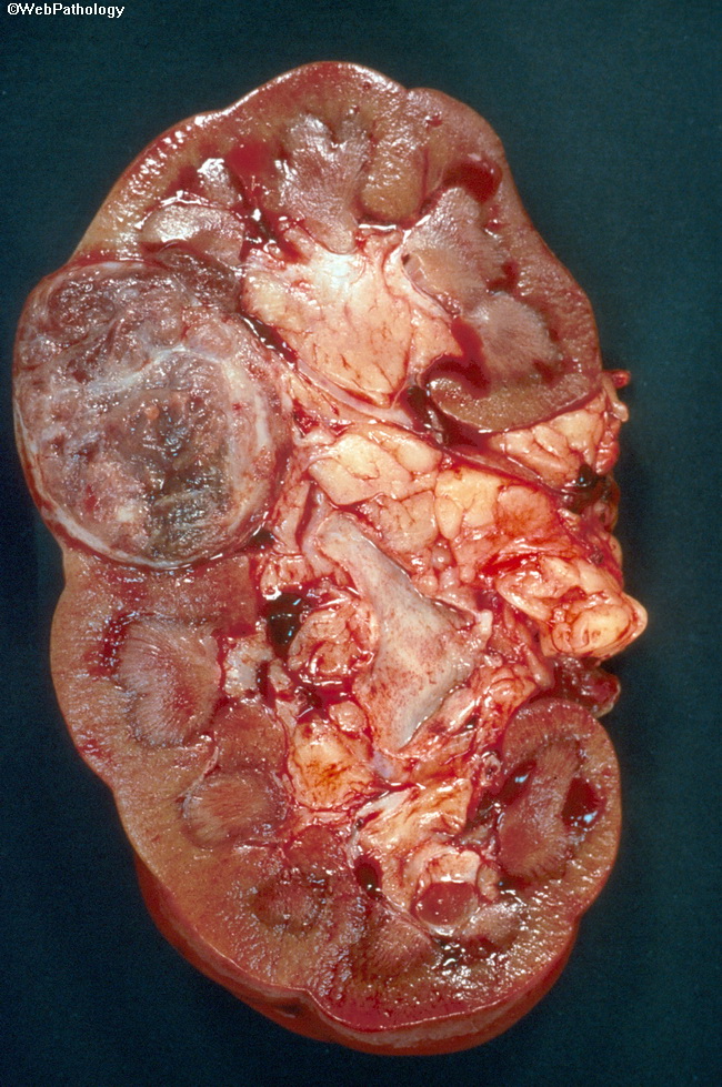 Kidney_ChromophobeRCC17.jpg