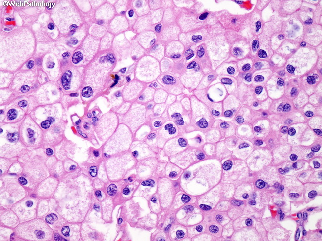 Kidney_ChromophobeRCC7.jpg