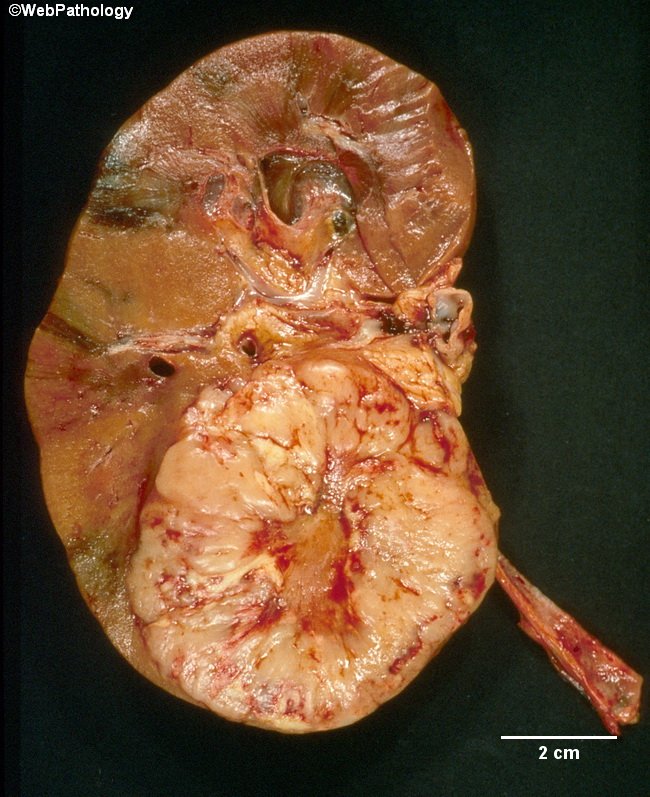 Kidney_Lymphoma_Gross1.jpg