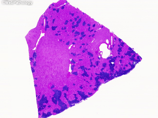 Kidney_Lymphoma_MantleCell1_contrast.jpg