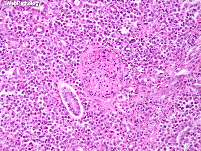 Kidney_MultipleMyeloma1.jpg