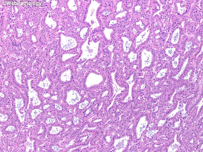 Kidney_Oncocytoma16.jpg