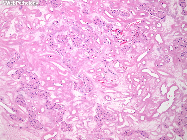 Kidney_Oncocytoma31.jpg