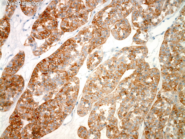 Kidney_Oncocytoma44_CD117.jpg