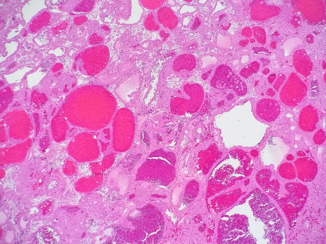 Kidney_Oncocytoma53_Telangiectatic_resized.jpg