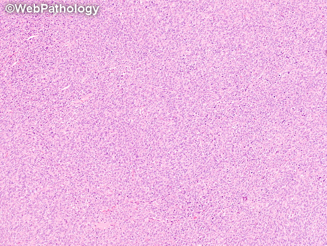 Kidney_Pediatric_CMN16_Cellular.jpg