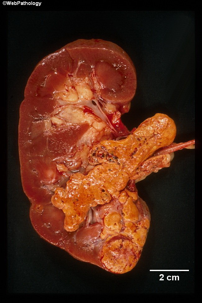 Kidney_RCC_Gross21_RenalVeinInvasion(1).jpg