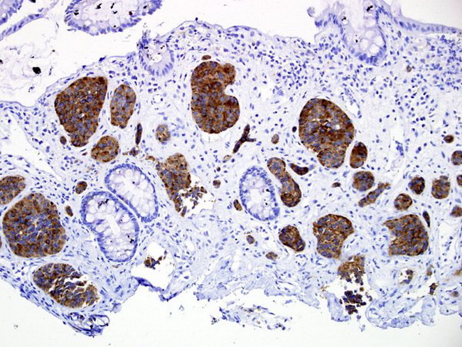 LargeBowel_NECarcinoma_Carcinoid6_resized.jpg
