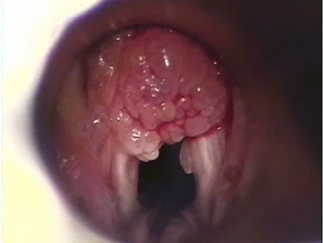 Squamous papilloma of the larynx