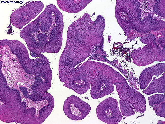 Papilloma larynx pathology, Laryngeal squamous papilloma pathology
