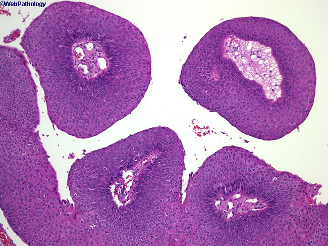 Laryngeal papillomatosis histology, Papilloma larynx pathology. Papilloma Viruses