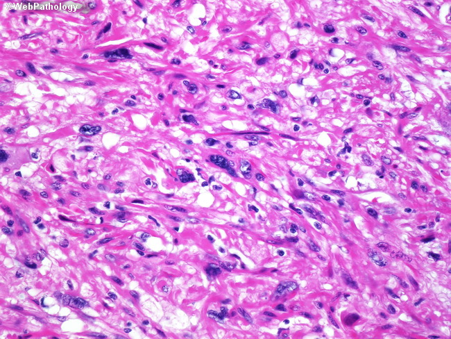 Leiomyosarcoma2_Vascular_SaphenousVein.jpg