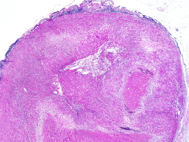 Leiomyosarcoma5_Vascular_SaphenousVein.jpg