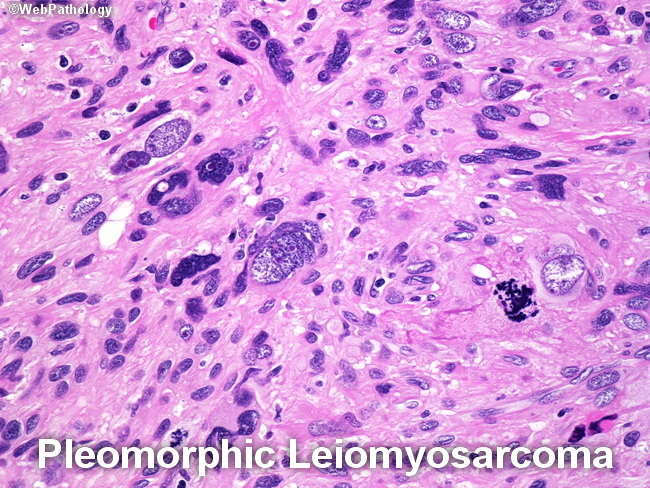 Leiomyosarcoma6_Pleomorphic1A.jpg