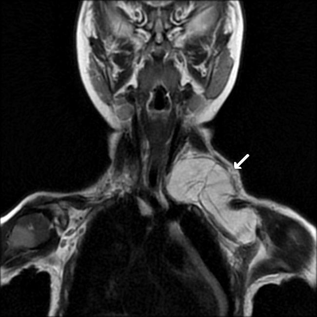 Lipoblastoma_Imaging1A_resized.jpg