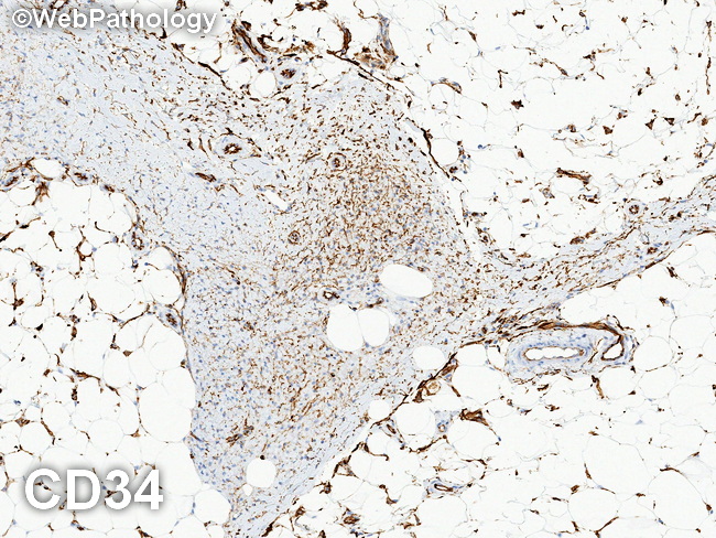 Lipofibromatosis6_CD34_resized.jpg
