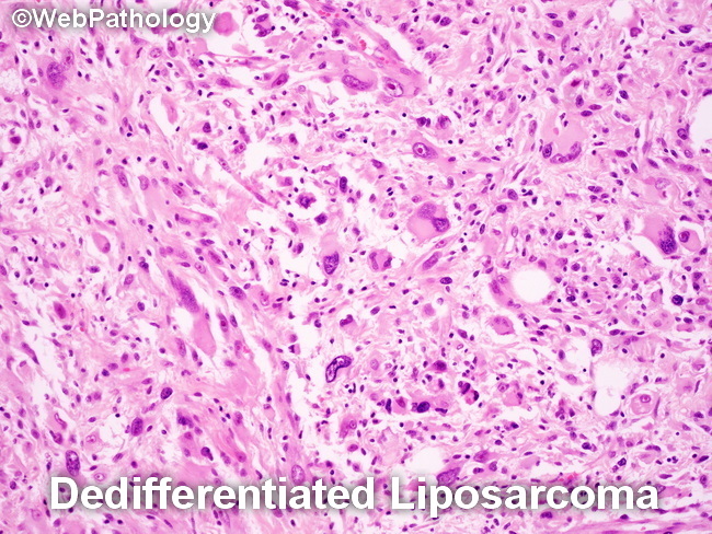 Liposarcoma_Dedifferentiated1A(1).jpg
