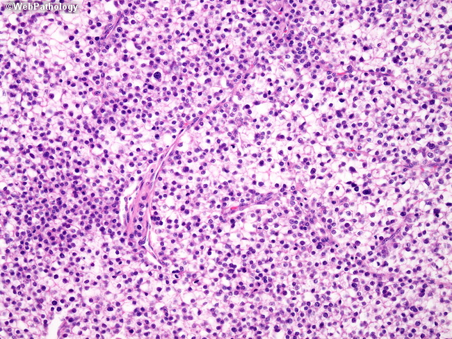 Liver_HCC22_ClearCell.jpg