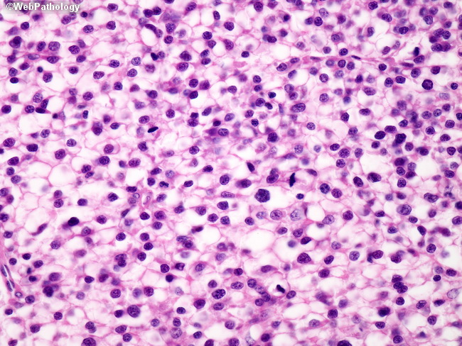 Liver_HCC23_ClearCell.jpg