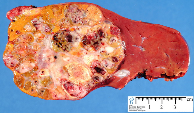 Liver_Hepatoblastoma1.jpg