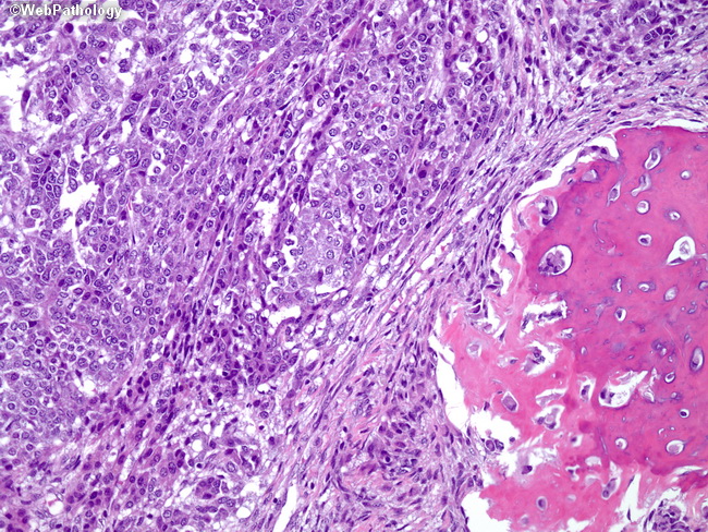 Liver_Hepatoblastoma11_Embryonal_Mesenchymal.jpg