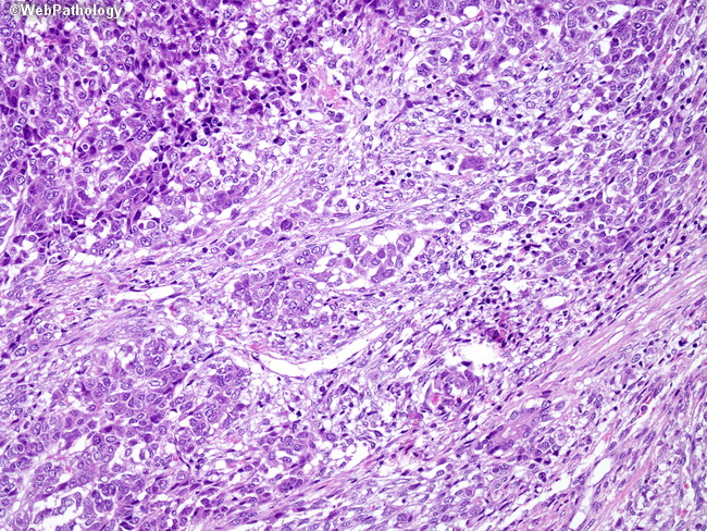 Liver_Hepatoblastoma13_Embryonal.jpg