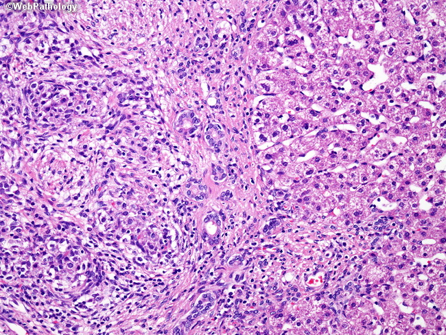 Liver_Hepatoblastoma15_Fetal_Embryonal.jpg