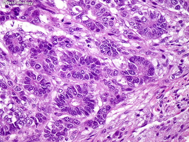 Liver_Hepatoblastoma16_Teratoid.jpg
