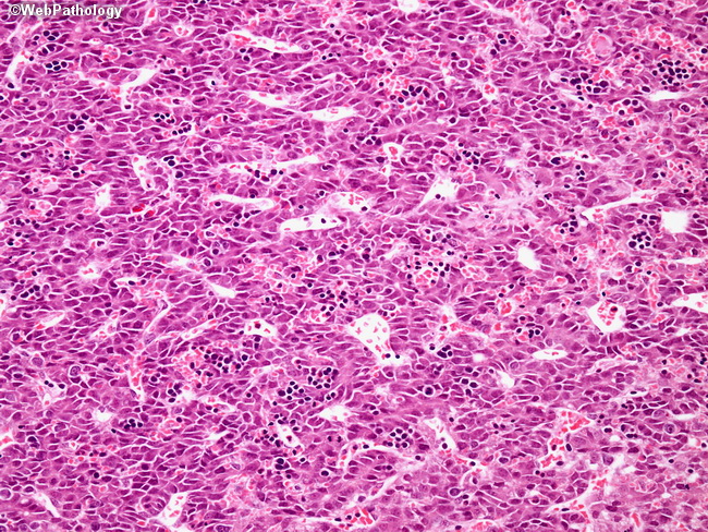 Liver_Hepatoblastoma17_Teratoid.jpg