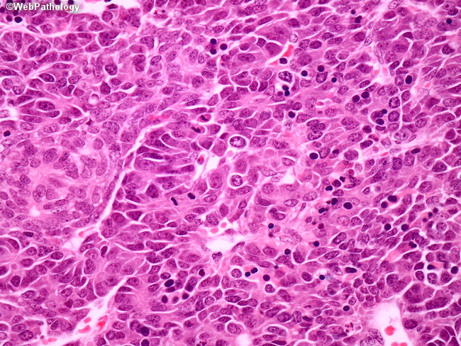 Liver_Hepatoblastoma18_Teratoid.jpg