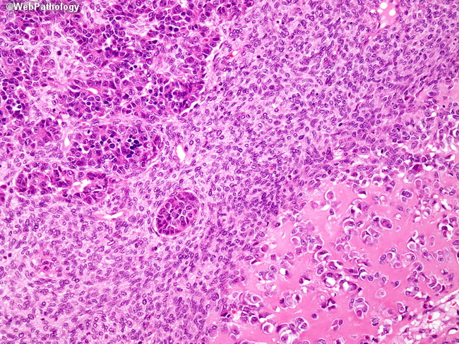 Liver_Hepatoblastoma21_Embryonal_Mesenchymal.jpg