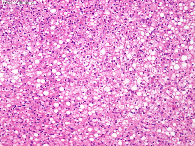 Liver_Hepatoblastoma23.jpg