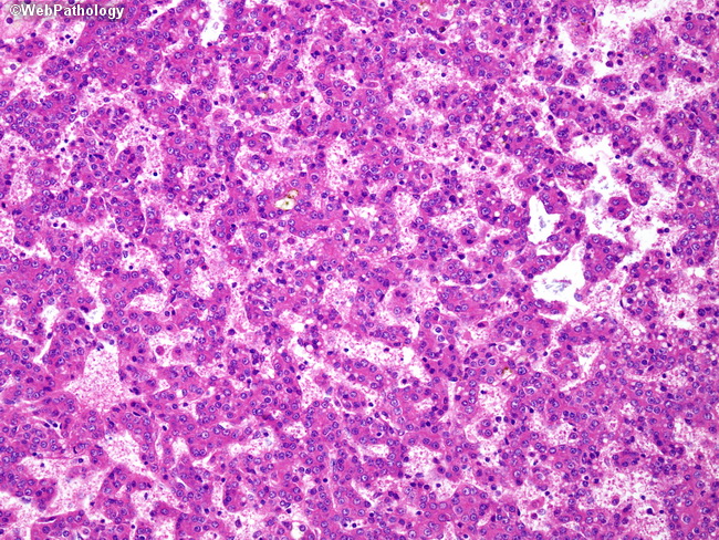Liver_Hepatoblastoma5_FetalPattern.jpg