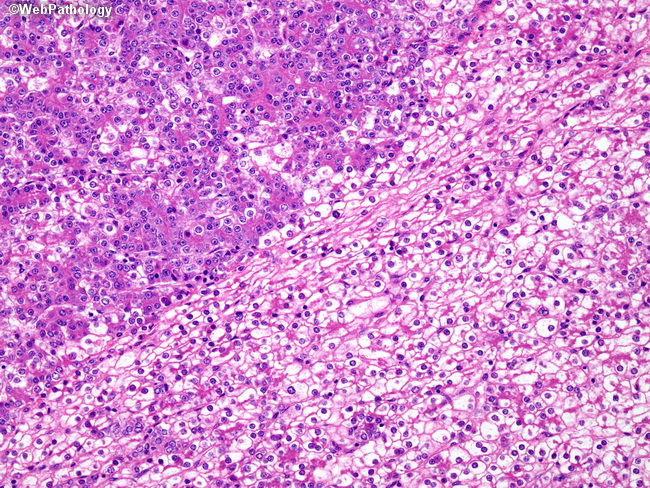 Liver_Hepatoblastoma6_FetalPattern.jpg