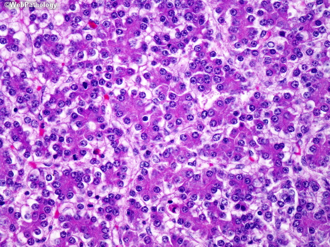Liver_Hepatoblastoma7_FetalPattern.jpg