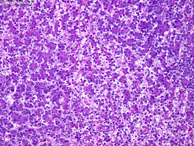 Liver_Hepatoblastoma8_Fetal1.jpg
