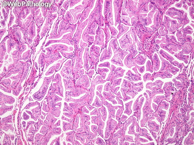 Lung_AdenoCA_InvasiveMucinous22_Papillary_Lepidic.jpg
