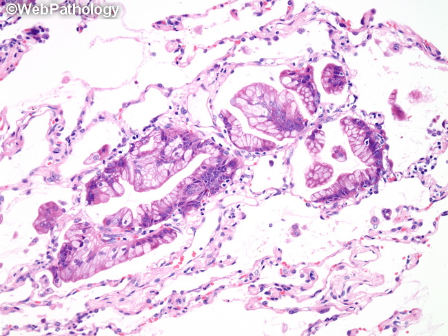 Lung_AdenoCA_InvasiveMucinous35_Lepidic.jpg