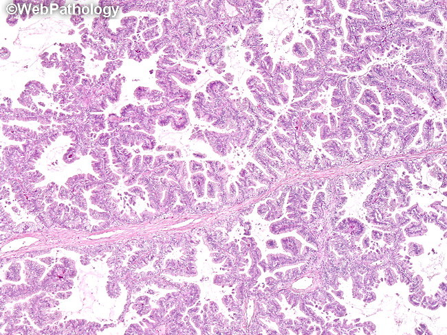 papillary lesion lung