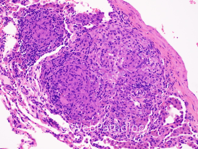 Lung_Coccidioidomycosis_lung12.jpg