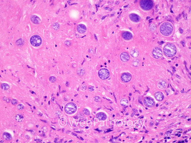Lung_Coccidioidomycosis_lung19.jpg
