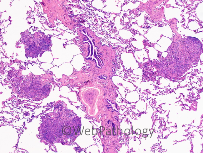 Lung_Coccidioidomycosis_lung6.jpg