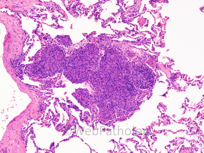 Lung_Coccidioidomycosis_lung8.jpg