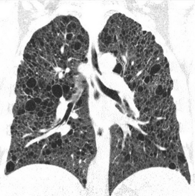 Lung_LAM_Radiology4.jpg