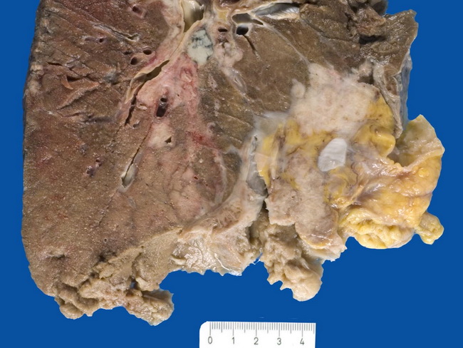 Lung_LargeCellNECarcinoma1_resized.jpg
