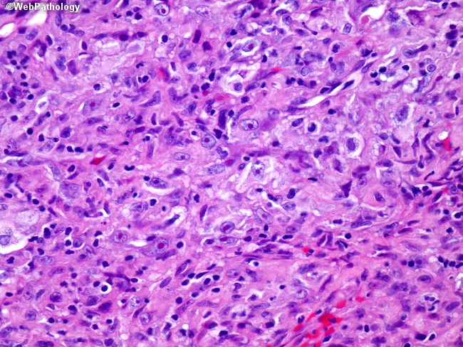 nf2 in mesothelioma