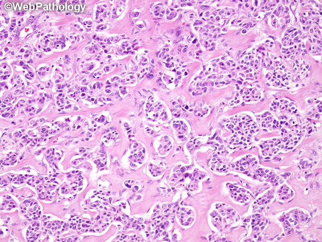Lung_Neoplastic_Carcinoid34.jpg