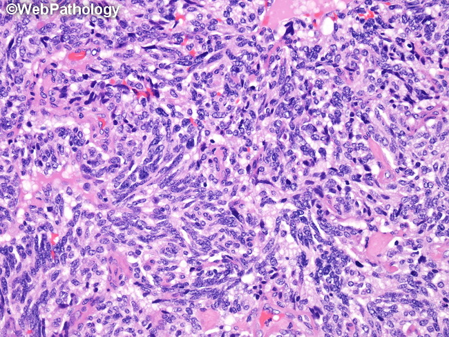 Lung_Neoplastic_Carcinoid_Spindle1.jpg
