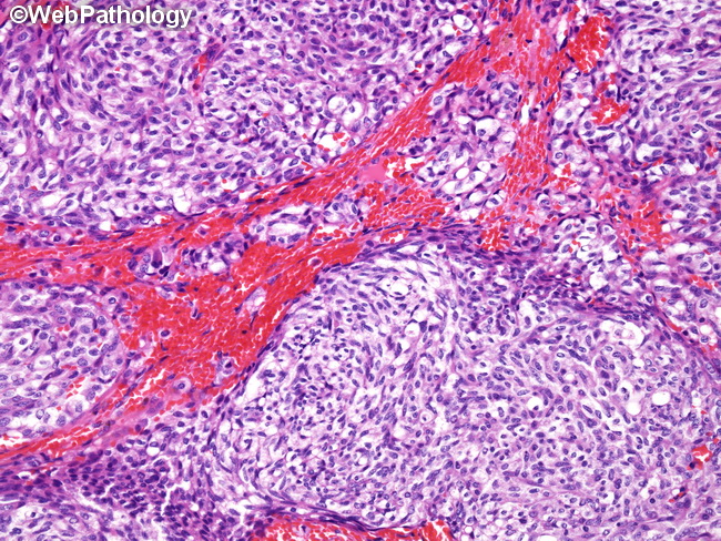 Lung_Neoplastic_Carcinoid_Spindle3.jpg