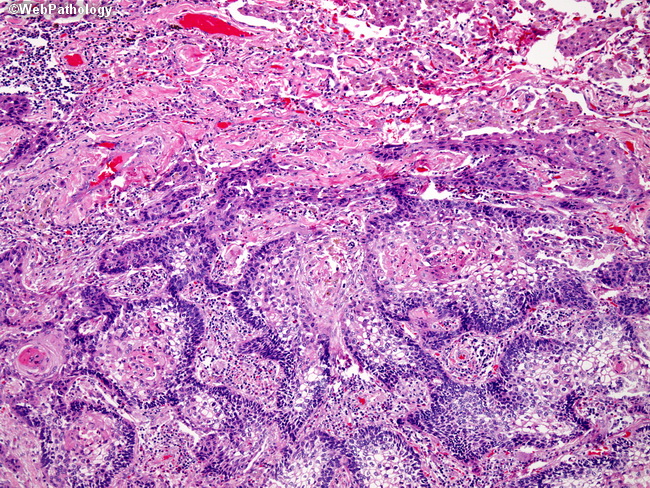 Lung_Neoplastic_SquamousCellCA18_Basaloid.jpg
